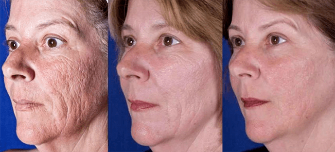 Results after laser facial rejuvenation procedure