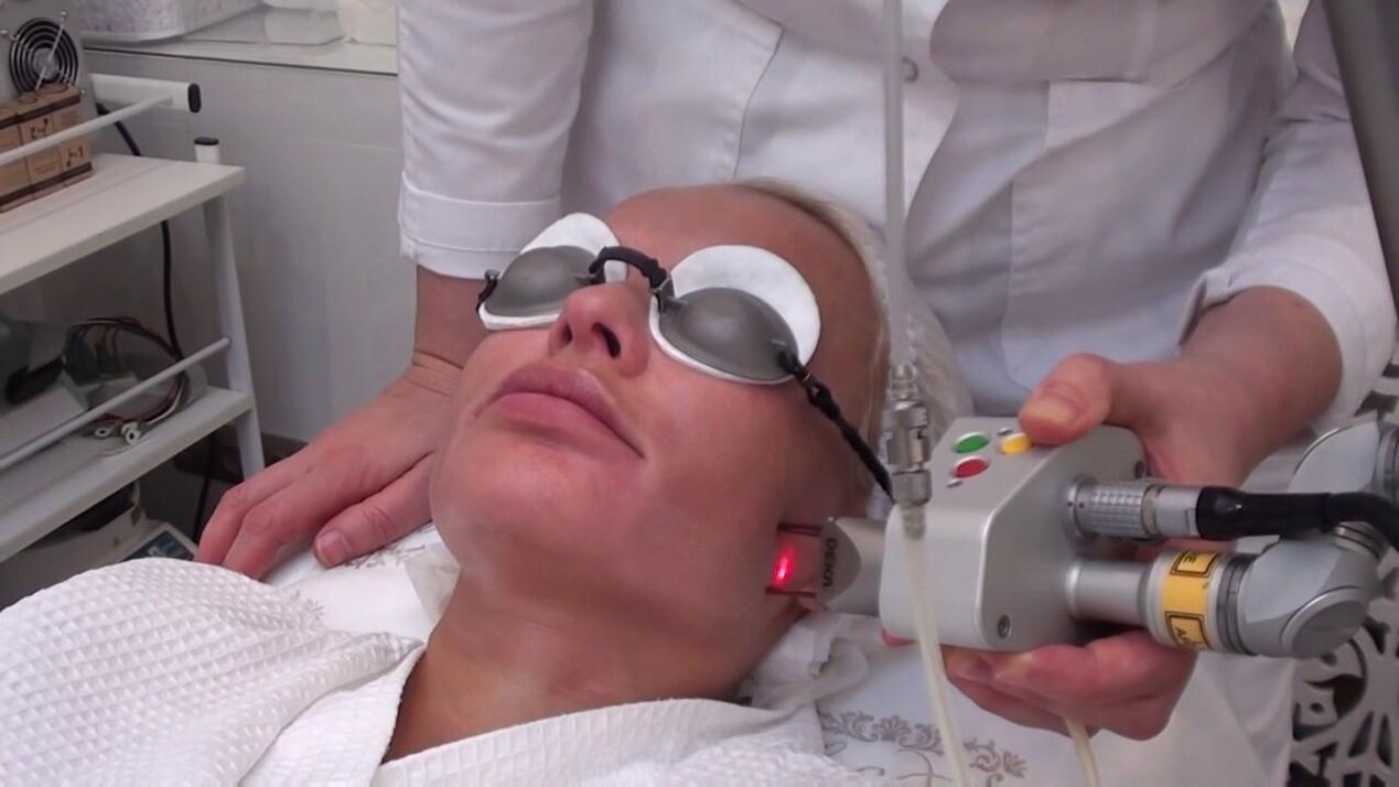 Treating problem areas of facial skin with laser beam
