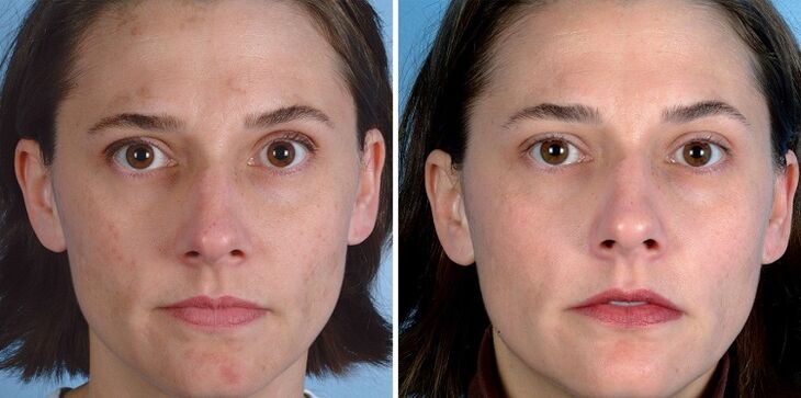 Before and after using the device for skin rejuvenation