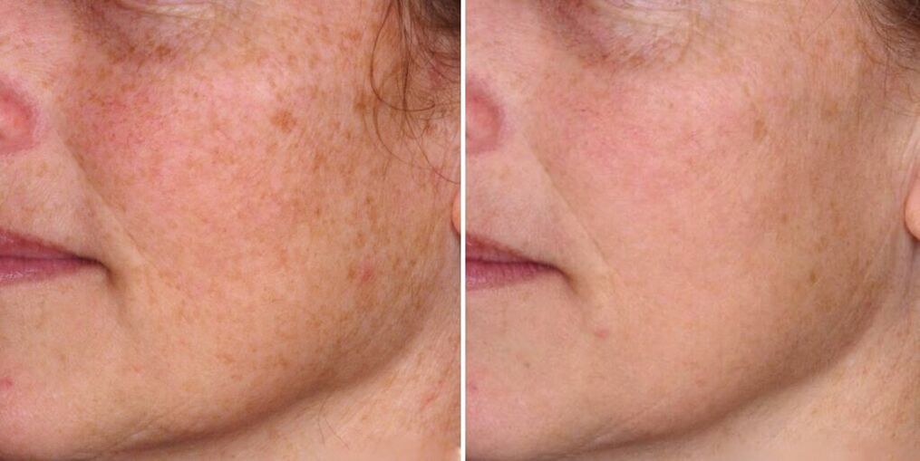 Before and after facial skin rejuvenation