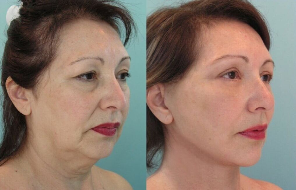 Before and after skin rejuvenation photos