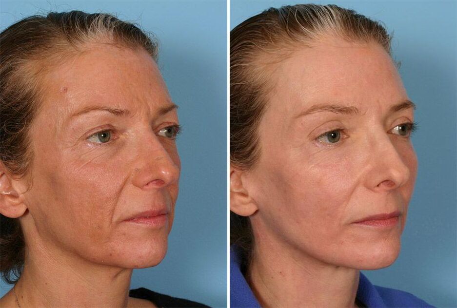 Laser rejuvenation before and after